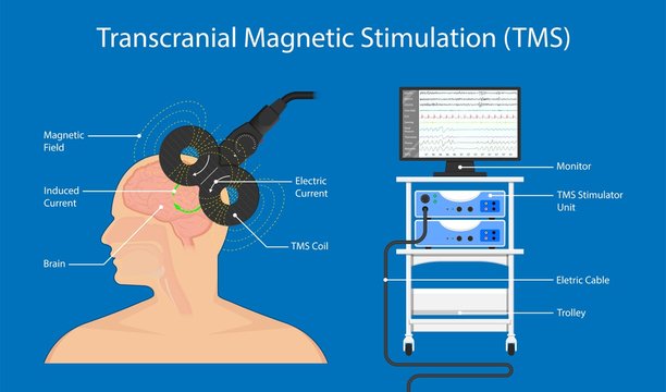 TMS Therapy