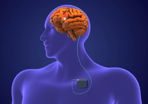 Neurostimulation